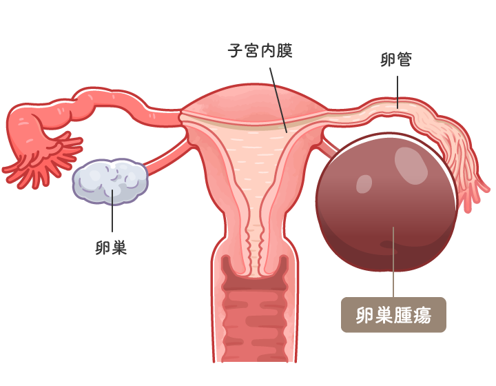 卵巣腫瘍